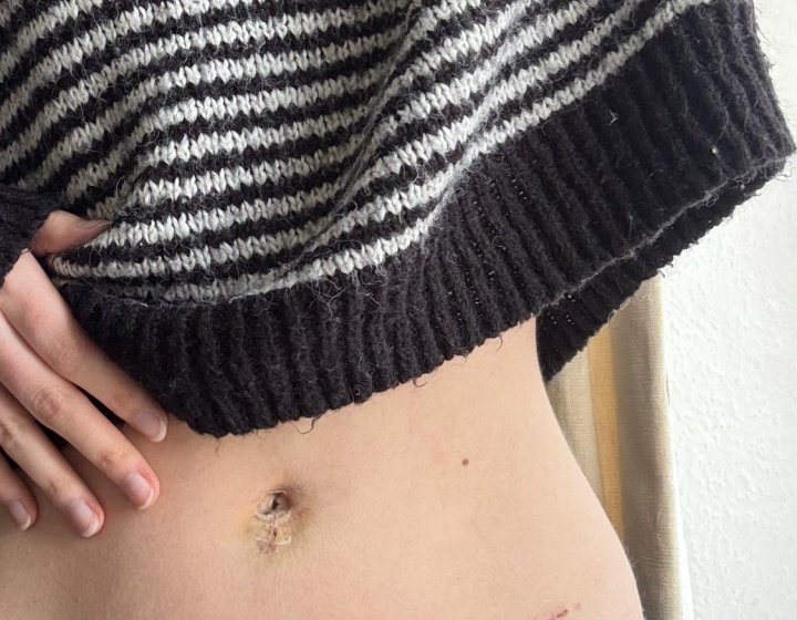 Photo of a hand touching bruised tummy button with striped jumper rising up