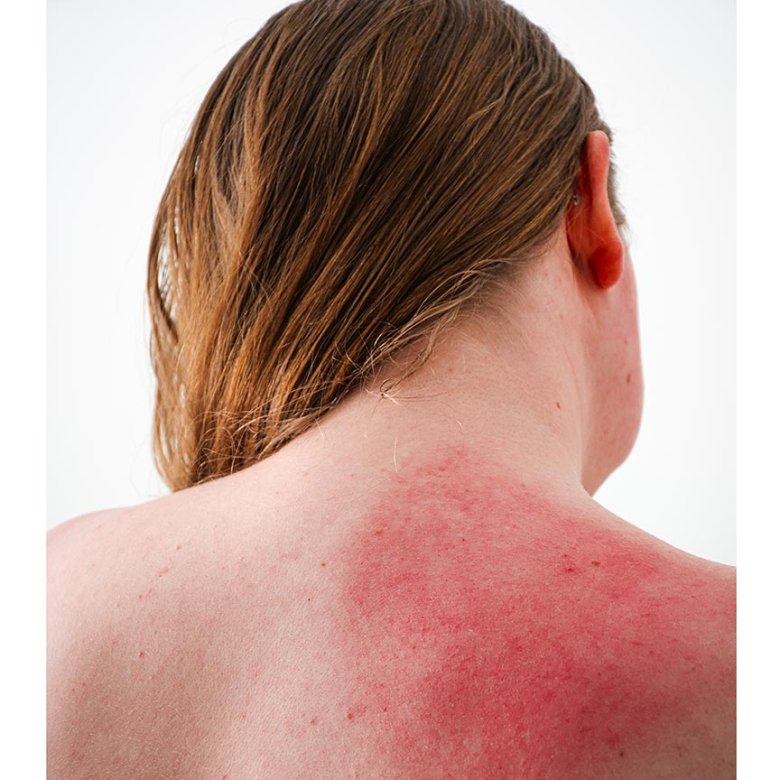 A photograph of the back of a woman with inflamed skin on her shoulder