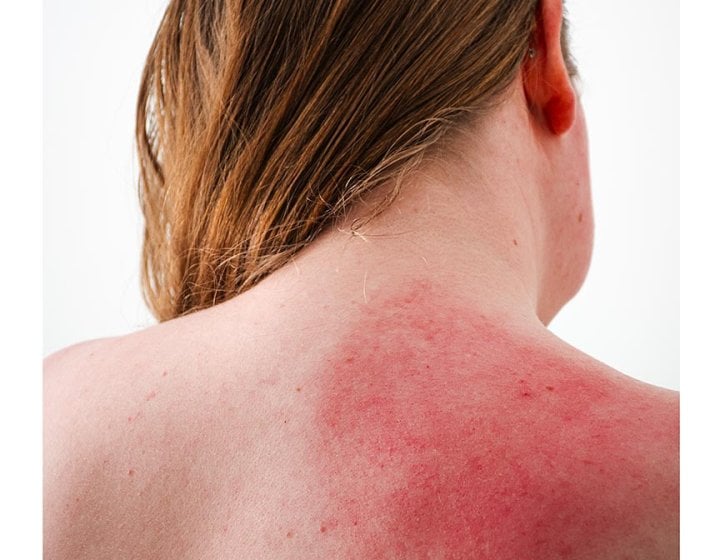 A photograph of the back of a woman with inflamed skin on her shoulder