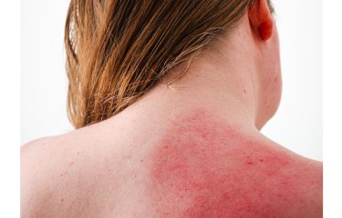 A photograph of the back of a woman with inflamed skin on her shoulder