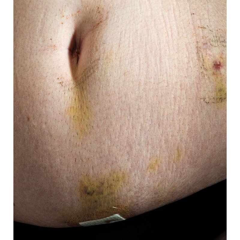 Photograph of a stomach with bruising